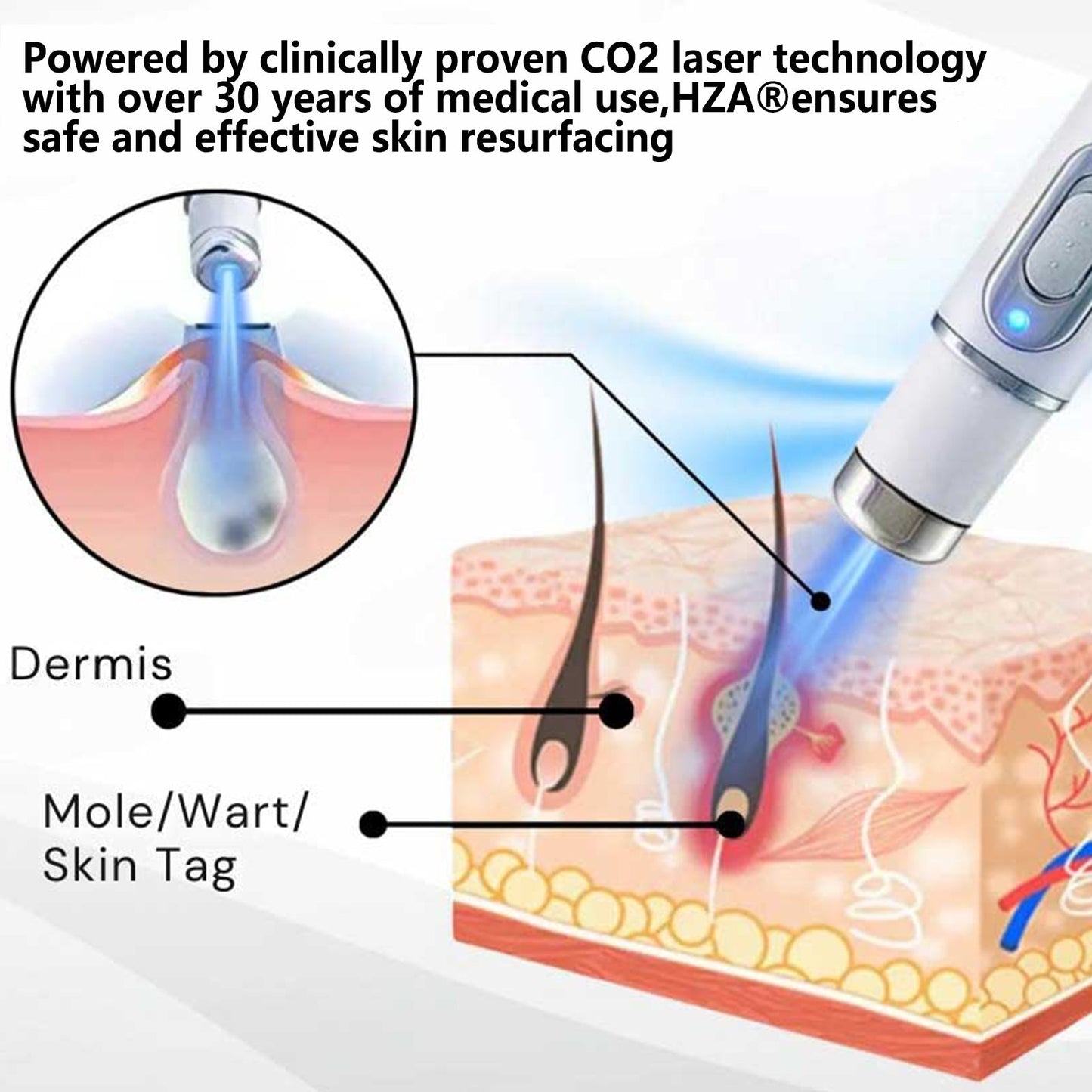 HZA® Non-Invasive Mole and Wart Removal Laser Pen(⏰Limited Time Discount⏰)